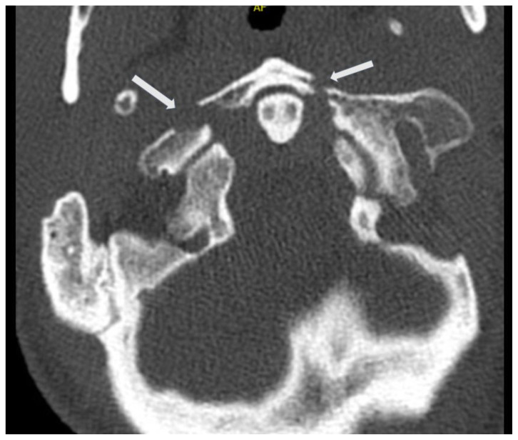 Jefferson Fracture and the Classification System for Atlas Fractures, A ...