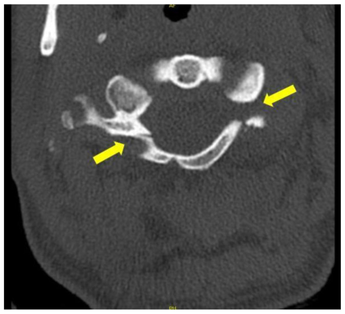 Jefferson Fracture and the Classification System for Atlas Fractures, A ...