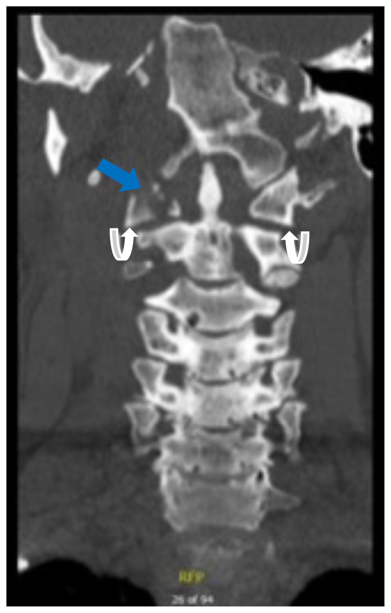 Jefferson Fracture and the Classification System for Atlas Fractures, A ...