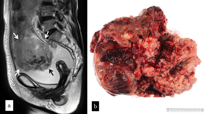 Bulky peritoneal carcinosarcoma with tiny high-grade serous carcinoma ...