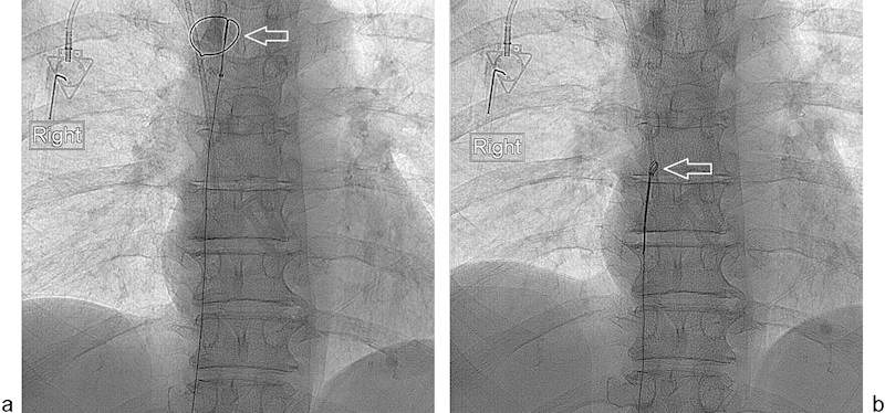 Management of Dysfunctional Catheters and Tubes Inserted by ...