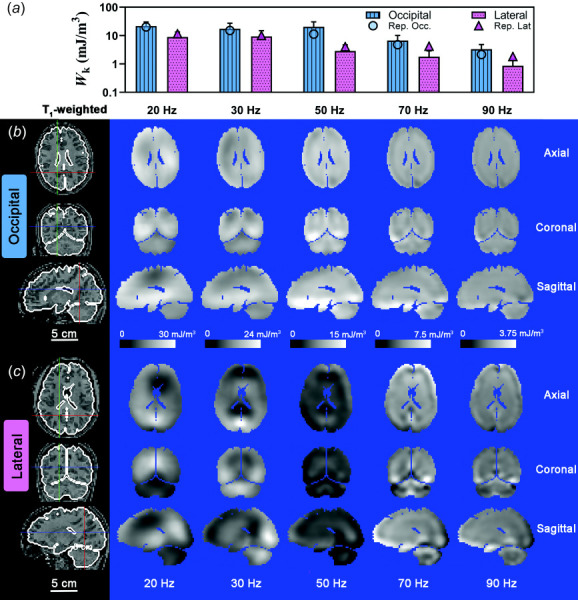 (a) Mean kinetic energy density, Wk, for each frequency and excitation direction. Error bars represent one standard deviation. A log scale is used in (a) for clarity. Symbols represent the mean Wk  for the participant data shown in (b) and (c). Spatial distribution of Wk for representative participants due to (B) occipital excitation and (c) lateral excitation shown on three orthogonal slice planes. Note that the color scale decreases from 30 mJ/m3 at 20 Hz to 3.75 mJ/m3 at 90 Hz. Scale bar applies to all images. Locations of axial slice, coronal slice and sagittal slice are denoted by blue, red, and green line, respectively, in the corresponding T1-weighted images. Participant IDs are U01_WUSTL_0015_01 (b) and U01_WUSTL_0014_01 (c).