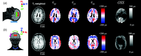 Strain components for (a) occipital and (b) lateral excitation computed from u˜ shown in Fig. 2. Images show T1-weighted axial slices at the level of the corpus callosum, three components of shear strain and time-averaged octahedral shear strain (OSS) at 50 Hz. The brain tissue mask (BTM) for each participant has been applied to the strain images.