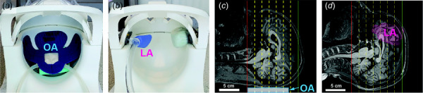 Positions of the occipital actuator (a) and lateral actuator (b) are shown in the 20 channel head coil. (c, d): T1-weighted images in midsagittal plane showing approximate location of occipital actuator (OA) or lateral actuator (LA), respectively. The extent of the MRE imaging volume is denoted by solid lines and the locations of reduced MEG strength image planes used to temporally unwrap MRE phase data are denoted by dashed lines.