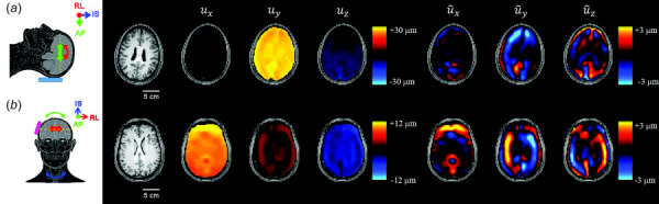 Relationships between total motion, rigid-body motion and wave motion. Schematics show trends in rigid- body motion for occipital excitation (a) and lateral excitation (b). Images show T1-weighted axial slices at the level of the corpus callosum, three components of total displacement u at 50 Hz, and three components of wave motion (u˜) after removal of rigid-body motion for two representative participants. Note different values for total motion of occipital and lateral excitation. Directions of motion are denoted by x (RL: right-left), y (AP: anterior-posterior), and z (IS: inferior-superior), computed with respect to the MRE image volume. “Head anatomy anterior lateral views” by Patrick Lynch, used under CC BY 2.5/ modified from original.