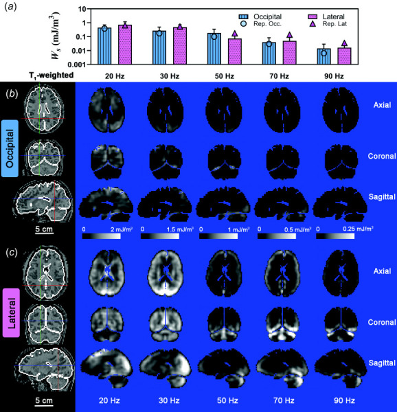 (a) Mean deviatoric strain energy density (Ws ), for each frequency and excitation direction. Error bars represent one standard deviation. A log scale is used in (a) for clarity. Symbols represent the mean Ws  for the participant data shown in (b) and (c). Spatial distribution of Ws  for representative participants due to (B) occipital excitation and (c) lateral excitation shown on three orthogonal slice planes. Note scale decreases from 2.0 mJ/m3 at 20 Hz to 0.25 mJ/m3 at 90 Hz. Scale bar applies to all images. Participant IDs are the same as Fig. 8.