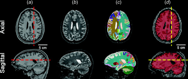 High resolution images of a representative participant's brain, rigidly registered to MNI-152 space. (a) T1-weighted, (b) T2-weighted, and (c) labeled brain, all with 0.8 mm isotropic voxels. (d) The labeled brain is rigidly registered to the MRE magnitude image volume and labels are used to create the brain tissue mask (red overlay) with 3 mm isotropic voxels. Dashed lines in (a) and (d) denote the location of the sagittal and axial slices. Slice planes in panel (d) are defined with respect to the scanner coordinate system in which images were acquired. Slice planes approximate anatomical planes but differ in each scan due to slight differences in head orientation. “Head anatomy anterior lateral views” by Patrick Lynch, used under CC BY 2.5/ modified from original.