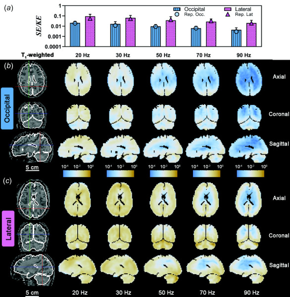 (a) Strain energy/kinetic energy ratio (SE/KE) for each frequency and excitation direction. Error bars represent one standard deviation. A log scale is used in (a) for clarity. Symbols represent the SE/KE values for the participant data shown in (b) and (c). Spatial distribution of Ws/Wk due to (b) occipital excitation and (c) lateral excitation shown on three orthogonal slice planes. Due to the large range of values, a log scale is used for image color values. Participant IDs are the same as Figs. 8 and 9.