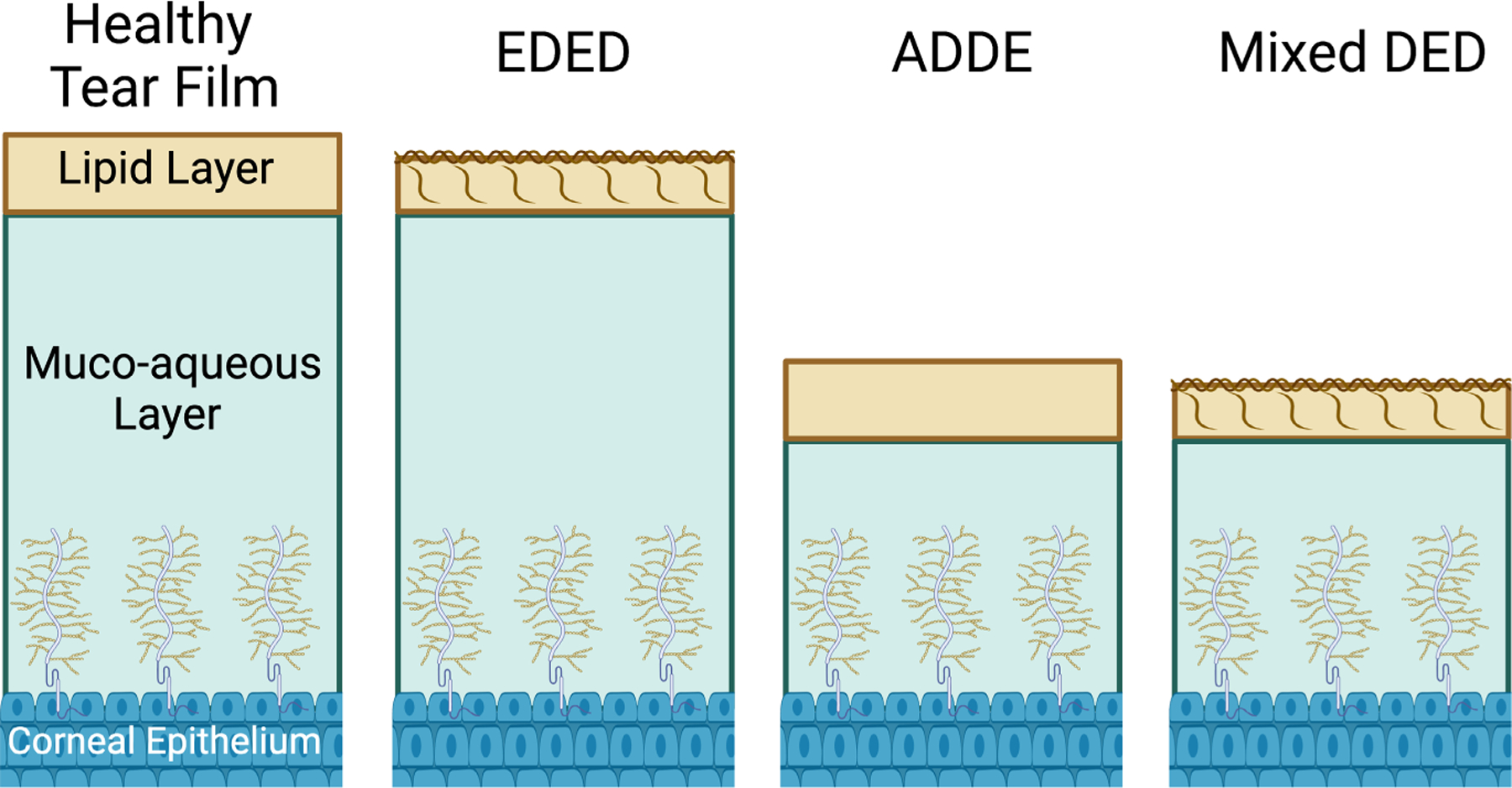 A comparative review of evaporative dry eye disease and meibomian gland ...