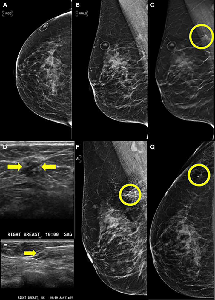 Images in a 66-year-old woman with previous history of left breast cancer treated with segmental excision and radiation therapy 7 years prior. Digital breast tomosynthesis (DBT) helped detect radial sclerosing lesion (RS) without atypia in the contralateral (right) breast, which was upgraded to invasive carcinoma after surgical excision. (A) Craniocaudal (CC) digital mammogram and (B) mediolateral oblique (MLO) digital mammogram as well as (C) MLO DBT views. Architectural distortion with possible associated mass in the upper right breast posteriorly was optimally observed on DBT MLO view (circle). (D, E) Sagittal and biopsy US images show a subtle 7-mm hypoechoic mass (arrows) corresponding to the DBT finding. (F, G) Postbiopsy mediolateral and laterally exaggerated CC digital mammograms demonstrate clip placement within the area of architectural distortion. Core biopsy returned radial scar, which was assessed as concordant. Surgical excision was recommended. Final surgical excisional pathologic analysis demonstrated a 7-mm estrogen receptor–positive, progesterone receptor–positive, human epidermal growth factor receptor 2–negative, invasive tubular carcinoma Nottingham grade I of III with no lymphovascular invasion, which was identified adjacent to, but distinct from, the biopsy needle track.