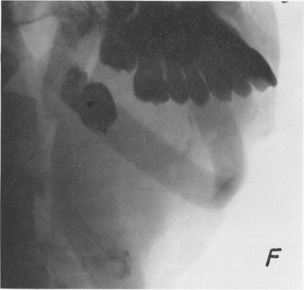 Fig. 1F.