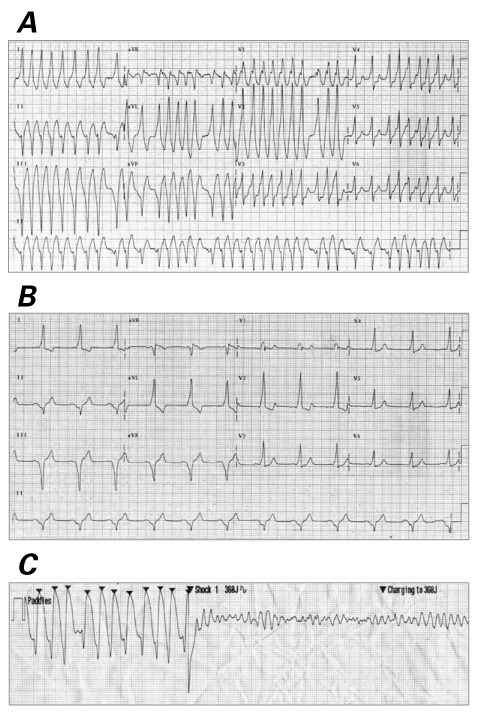 Iatrogenic Ventricular Fibrillation after Direct-Current Cardioversion ...