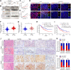 Figure 6. Inhibition of DHCR24 suppresses tumor growth in PDXs from LN-metastatic bladder cancer. A, Schematic illustration of the construction of the PDX model. B–D, Images and quantification of the tumor volume in mice treated with sh-DHCR24 or sh-NC (n = 6 per patient). E, Representative images of immunofluorescence staining of DHCR24, TBK1, and VEGFC expression and LYVE1–indicated lymphatic vessel density in the tumor tissues from PDXs. F and G, qRT‒PCR analysis of TBK1 expression in bladder cancer tissues versus NATs and LN-positive versus LN-negative bladder cancer tissues (n = 296). H and I, Kaplan‒Meier survival analysis of OS (H) and DFS (I) in patients with bladder cancer with high versus low TBK1 expression. The cutoff value is the median. J–L, Representative IHC images and correlation analysis of DHCR24, TBK1, and VEGFC expression and LYVE1–indicated lymphatic vessel density in both intratumoral and peritumoral regions of bladder cancer tissues (n = 296). Scale bars, 50 μm. H&E, hematoxylin and eosin.The significant difference was assessed through two-tailed Student t test in C and D; the nonparametric Mann–Whitney U test in F and G; and the χ2 test in K and L. **, P < 0.01.
