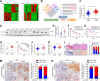 Figure 1. DHCR24 positively correlates with LN metastasis of bladder cancer. A, Heat map of protein-coding genes differentially expressed in bladder cancer tissues and NATs and in bladder cancer tissues with or without LN metastasis. B, Schematic illustration of the screening process of co-upregulated protein-coding genes in both bladder cancer tissues and LN-positive bladder cancer tissues and the TCGA database. C, qRT‒PCR analysis of DHCR24 expression in bladder cancer tissues and NATs (n = 296). D, Representative Western blot images of DHCR24 expression in bladder cancer tissues and NATs (n = 40). E, Quantification of DHCR24 expression by Western blot analysis in 40 paired bladder cancer and NATs. F and G, Kaplan‒Meier survival analysis of the DFS (F) and OS (G) of patients with bladder cancer with low versus high DHCR24 expression. The cutoff value is the median. H, Analysis of DHCR24 expression in bladder cancer tissues and NATs from the TCGA database. I, Kaplan‒Meier survival analysis of the OS of patients with bladder cancer with low versus high DHCR24 expression from the TCGA database. The cutoff value is the median. J, qRT‒PCR analysis of DHCR24 expression in bladder cancer tissues with or without LN metastasis (n = 296). K, Analysis of DHCR24 expression in bladder cancer tissues with or without LN metastasis from the TCGA database. L, Representative IHC images and quantification of DHCR24 expression in NATs and LN-negative and LN-positive bladder cancer tissues. Scale bars, 50 μm. H&E, hematoxylin and eosin. M and N, Representative IHC images and quantification of DHCR24 expression and LYVE1–indicated lymphatic vessels in peritumoral (M) and intratumoral (N) regions of bladder cancer tissues. Scale bars, 50 μm. Significant differences were assessed through the nonparametric Mann–Whitney U test in C, E, H, J, and K and the χ2 test in L and N. *, P < 0.05; **, P < 0.01. BCa, bladder cancer.