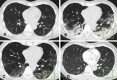 High-resolution noncontrast chest CT findings in a 70-year-old man with COVID-19 pneumonia and previous mitral valve replacement during 1-year follow-up. (A) Archive control noncontrast CT axial section obtained 1 year before COVID-19 shows the absence of any focal or diffuse and/or infiltrative lung disease (box). (B) Baseline image obtained at the onset of COVID-19 pneumonia shows bilateral consolidations (box) in the lower lung lobes (lung severity score, 12 out of 20). (C) Image obtained at 6-month follow-up shows almost complete reabsorption of consolidations. Mild GGOs are detectable in the lower lobes, and there is evidence of linear atelectasis (box). (D) Image obtained at 1-year follow-up shows complete resolutoin of both GGOs and linear atelectasis (box).