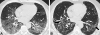 High-resolution noncontrast chest CT findings in a 72-year-old man with COVID-19 pneumonia during 1-year follow-up. (A) Baseline axial section shows extensive hazy ground-glass opacities (GGOs) with dark bronchogram signs in the lower lung lobes (lung severity score, 12 out of 20). (B) Image obtained at 1-year follow-up shows incomplete resolution of areas of GGO and the presence of reticulation and multiple areas of medullary traction bronchiectasis and/or bronchiolectasis (arrows) with “corkscrew” features suggestive of architectural fibrotic distortion, as for an overlapping fibrosing organizing pneumonia and/or nonspecific interstitial pneumonia pattern.