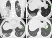 High-resolution noncontrast chest CT findings in a 62-year-old man with COVID-19 pneumonia during 1-year follow-up. (A) Coronal section (multiplanar reconstruction) at baseline shows diffuse bilateral hazy ground-glass opacity (GGO) (lung severity score, 10 out of 20). (B) Representative axial section at baseline with evidence of GGO in the right lower lobe along with the sign of a dark bronchogram. No abnormalities are present in the left lower lobe for comparison (box). (C) Scan obtained at 3-month follow-up shows residual GGO. Consolidations are present in both lower lung lobes, likely due to transient disease worsening involving the right lower lobe. A small segmental bronchiectasis is appreciable in close proximity to a band-like consolidation in the left lower lobe (box). (D) Scan obtained at 1-year follow-up shows complete resolution of GGO and consolidations and disappearance of segmental bronchiectasis (box).