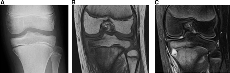 Radiological changes in the formation of Brodie's abscess by sequential ...