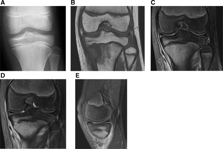 Radiological changes in the formation of Brodie's abscess by sequential ...