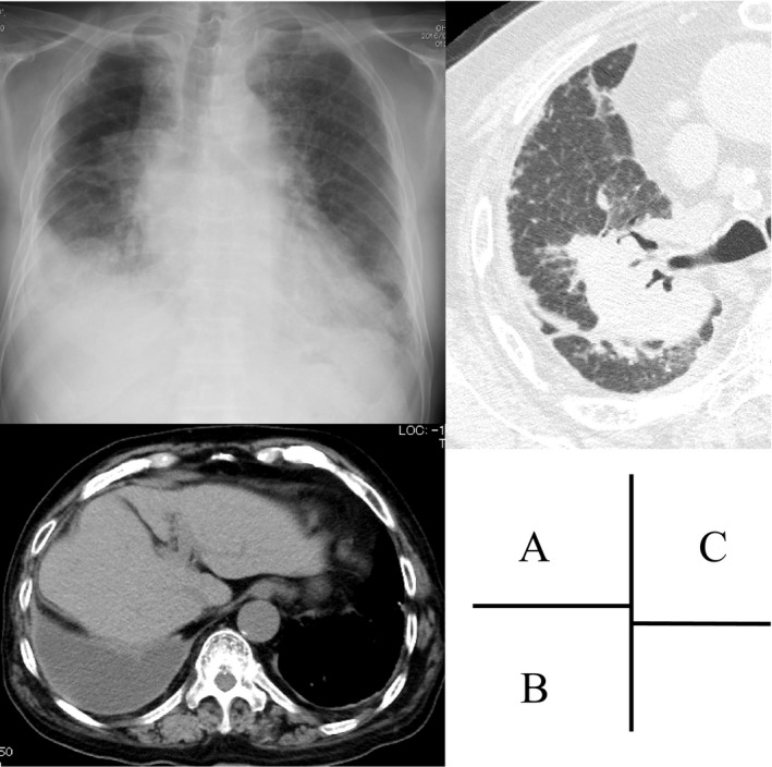 A case of empyema and septic arthritis due to nocardia farcinica pmc