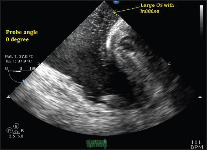 Imaging coronary sinus in modified bicaval view - PMC