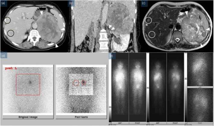 Long‐term Survival Of A Patient With Refractory Advanced Adrenocortical 