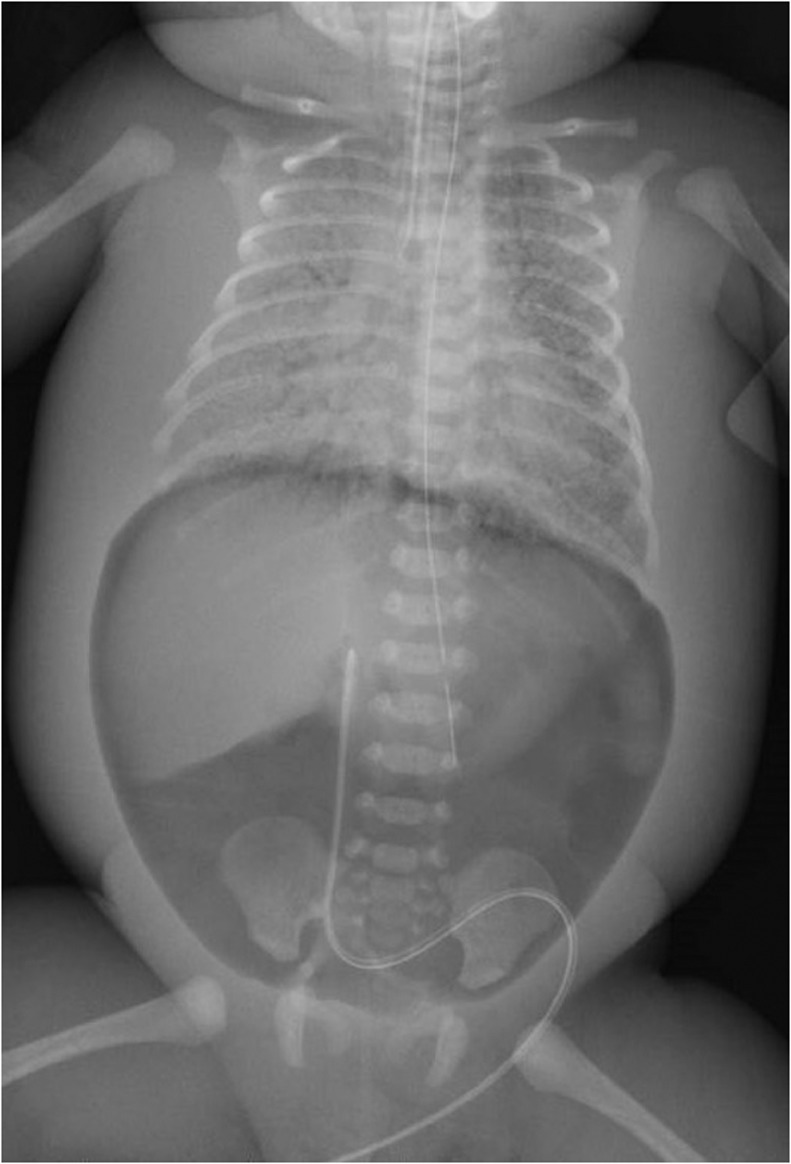 Idiopathic Pneumoperitoneum Without Gastrointestinal Perforation In A idiopathic-pneumoperitoneum-without-gastrointestinal-perforation-in-a