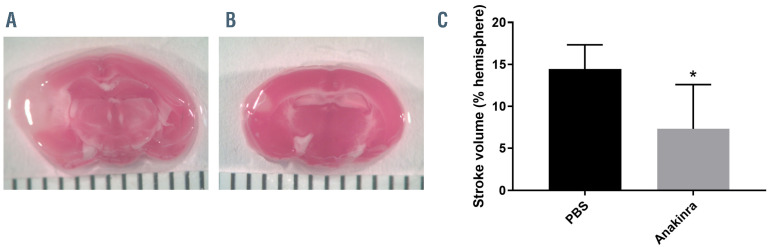 Inter Leukin-1 Receptor Inhibition Reduces Stroke Size In A Murine 