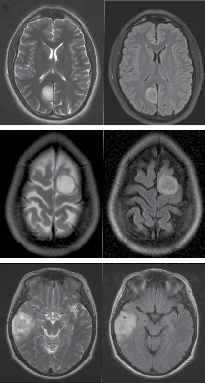 The T2-FLAIR mismatch sign as an imaging marker for non-enhancing IDH ...