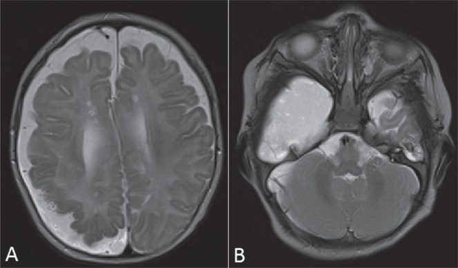 Oculoectodermal Syndrome - Encephalocraniocutaneous Lipomatosis ...