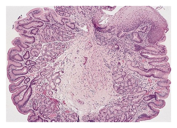 Esophageal Inlet Patch - PMC