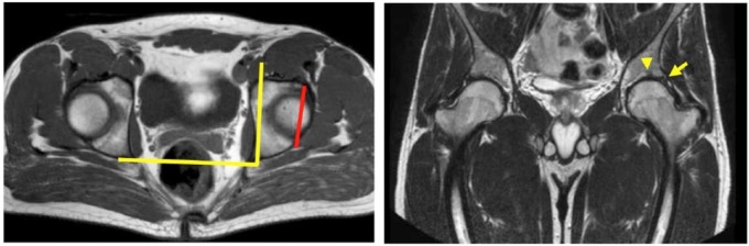 Acetabular retroversion: Diagnosis and treatment - PMC