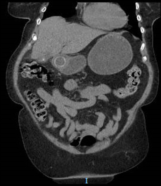 Bouveret Syndrome: When a Stone Cannot Pass the Pylorus - PMC