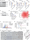 Figure 2. FOXM1 regulates the sensitivity of neuroblastoma cells to simvastatin. A, Immunoblot analysis of FOXM1 and its target cyclin B1 (CCNB1) in SK-N-DZ cells with inducible FOXM1 expression in the absence of doxycycline (Doxy-). β-actin levels are shown as loading control. B, Cell growth assays of neuroblastoma cell lines without or with FOXM1 induction that were treated with DMSO or simvastatin. FOXM1 induction conferred resistance to simvastatin. P values were determined by two-tailed Student t test. C, Immunoblot analysis of shRNA-mediated FOXM1 knockdown in BE(2)-C cells. α-Tubulin levels are shown as loading control. D, Cell growth assays of BE (2)-C cells without (shGFP) or with FOXM1 knockdown (shFOXM1) that were treated with DMSO or simvastatin. Synergistic effect determined by the Bliss reference model. E, Two-dimensional synergy plot showing additive or synergistic interaction between simvastatin and thiostrepton (FOXM1i), with indicated Bliss synergy scores: <10, additive effect; >10, synergistic effect. F and G, Tumor growth (F) and event-free survival (G) curves for NOD/SCID mice bearing BE (2)-C xenografts treated with vehicle, FOXM1i, simvastatin, or combination of simvastatin and FOXM1i. Treatment was started on the day of inoculation and ended on day 50 post-inoculation. Log-rank test P values are indicated for individual or combination of the drugs versus vehicle and drug combination versus FOXM1i. H, Representative images of IHC staining of cleaved caspase-3 from two xenografts treated with vehicle, FOXM1i, simvastatin, or combination of FOXM1i and simvastatin. I, Violin plot of apoptosis levels quantified as areas of cleaved caspase-3–positive staining in 8–10 IHC images (200×) from 2–3 xenografts per group. P values were determined by one-way ANOVA. *, P < 0.05; ***, P < 0.001; ****, P < 0.0001.