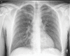 Top: Images in a 74-year-old man with positive reverse transcription polymerase chain reaction (RT-PCR) test results for severe acute respiratory syndrome coronavirus 2 (SARS-CoV-2) viral infection. (a) Frontal chest radiograph. (b) Artificial intelligence (AI) system heat map overlaid on a shows pneumonia-related features. The AI system score for this subject is 99.8. Bottom: Images in a 30-year-old man with negative RT-PCR test results for SARS-CoV-2 viral infection. (c) Frontal chest radiograph. (d) AI system heat map overlaid on c. The AI system score for this subject is 0.2.