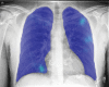 Top: Images in a 74-year-old man with positive reverse transcription polymerase chain reaction (RT-PCR) test results for severe acute respiratory syndrome coronavirus 2 (SARS-CoV-2) viral infection. (a) Frontal chest radiograph. (b) Artificial intelligence (AI) system heat map overlaid on a shows pneumonia-related features. The AI system score for this subject is 99.8. Bottom: Images in a 30-year-old man with negative RT-PCR test results for SARS-CoV-2 viral infection. (c) Frontal chest radiograph. (d) AI system heat map overlaid on c. The AI system score for this subject is 0.2.