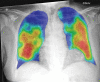 Top: Images in a 74-year-old man with positive reverse transcription polymerase chain reaction (RT-PCR) test results for severe acute respiratory syndrome coronavirus 2 (SARS-CoV-2) viral infection. (a) Frontal chest radiograph. (b) Artificial intelligence (AI) system heat map overlaid on a shows pneumonia-related features. The AI system score for this subject is 99.8. Bottom: Images in a 30-year-old man with negative RT-PCR test results for SARS-CoV-2 viral infection. (c) Frontal chest radiograph. (d) AI system heat map overlaid on c. The AI system score for this subject is 0.2.