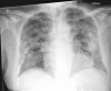 Top: Images in a 74-year-old man with positive reverse transcription polymerase chain reaction (RT-PCR) test results for severe acute respiratory syndrome coronavirus 2 (SARS-CoV-2) viral infection. (a) Frontal chest radiograph. (b) Artificial intelligence (AI) system heat map overlaid on a shows pneumonia-related features. The AI system score for this subject is 99.8. Bottom: Images in a 30-year-old man with negative RT-PCR test results for SARS-CoV-2 viral infection. (c) Frontal chest radiograph. (d) AI system heat map overlaid on c. The AI system score for this subject is 0.2.