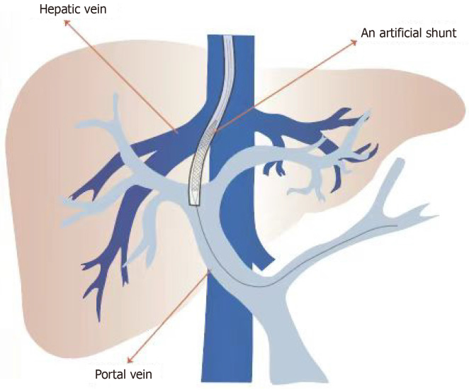 Drainage of ascites in cirrhosis - PMC