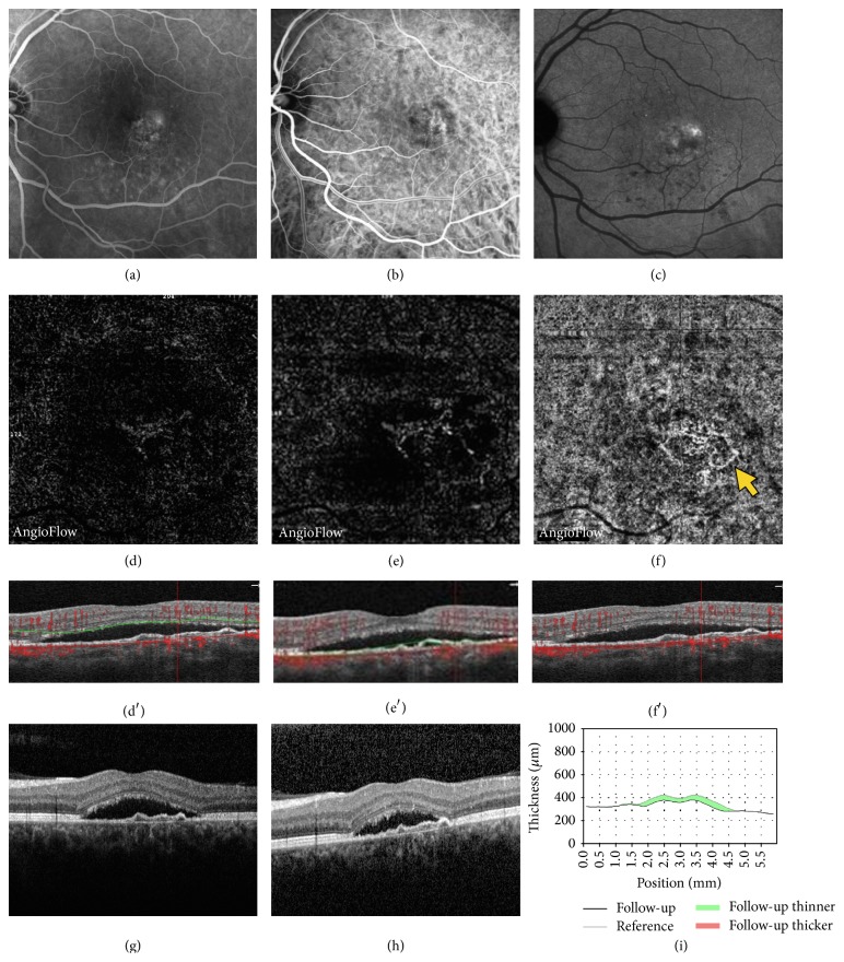 Optical Coherence Tomography Angiography in Central Serous ...