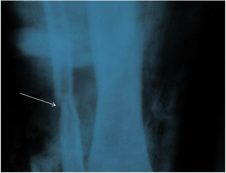 Figure 5: Shaft of left fibula fracture