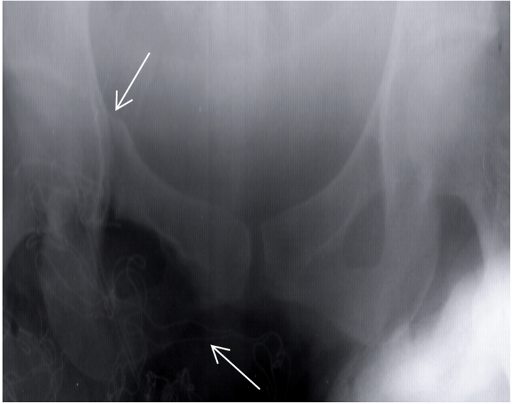 Figure 3: Superior and inferior right ramous of pelvic Fracture