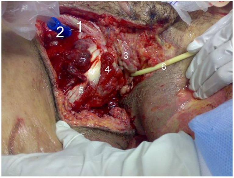 Figure 6: Perineum areas during irrigation-debridement.