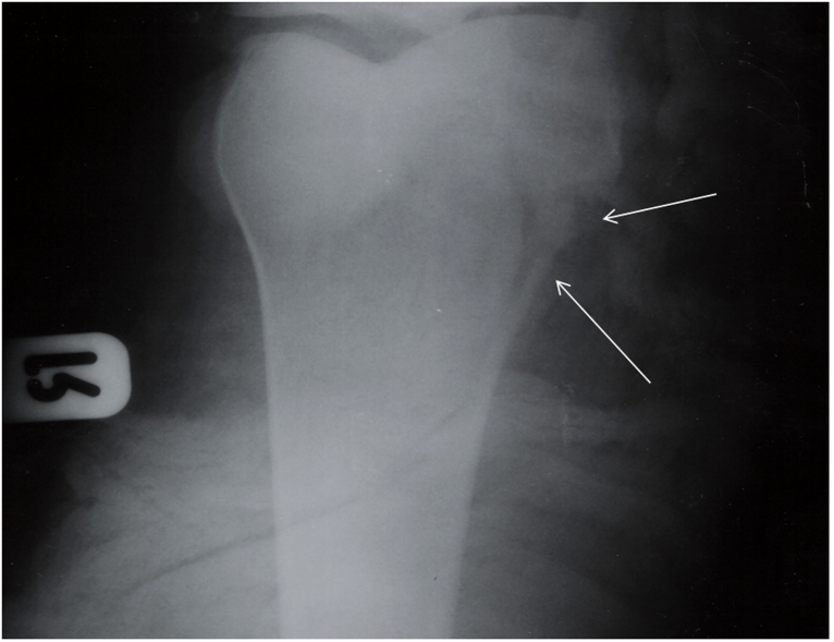 Figure 4: Proximal of right tibia fracture