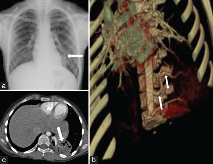 Cystic And Cavitary Lung Lesions In Children: Radiologic Findings With ...