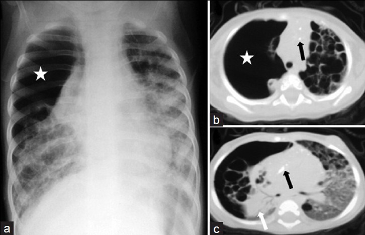 Cystic And Cavitary Lung Lesions In Children: Radiologic Findings With ...