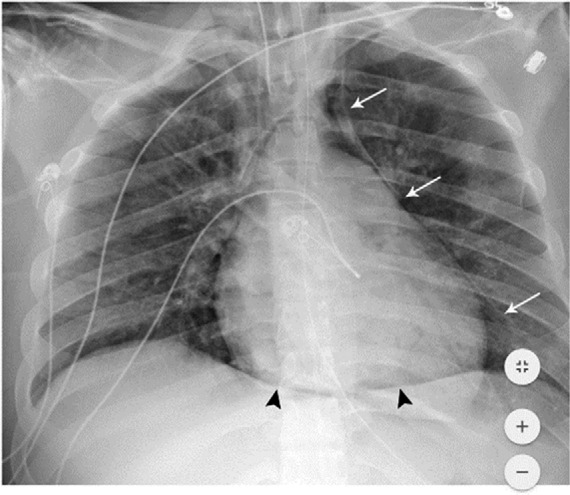 Pneumomediastinum and pneumopericardium. 18-year-old man without significant medical history was intubated 5 days after admission, and developed pneumomediastinum and pneumopericardium the same day. Frontal chest radiograph depicts mediastinal air bilaterally (white arrows). The ‘continuous diaphragm sign’ (black arrowheads) indicates air beneath the heart. Note diffuse hazy interstitial lung markings.