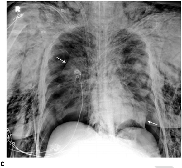 Pneumomediastinum and Bilateral Pneumothoraces, Separated by 7 days. 20-year-old woman intubated 5 days after admission. (a) Frontal chest radiograph depicts moderate pneumomediastinum (black arrows) and subcutaneous emphysema. (b) Frontal radiograph 3 days later demonstrates resolution of pneumomediastinum, and persistent mild subcutaneous emphysema. The superior and inferior extracorporeal membrane oxygenation catheters (arrowheads) were placed the preceding day. (c). Four days later, she developed large bilateral pneumothoraces (white arrows), and extensive subcutaneous emphysema.