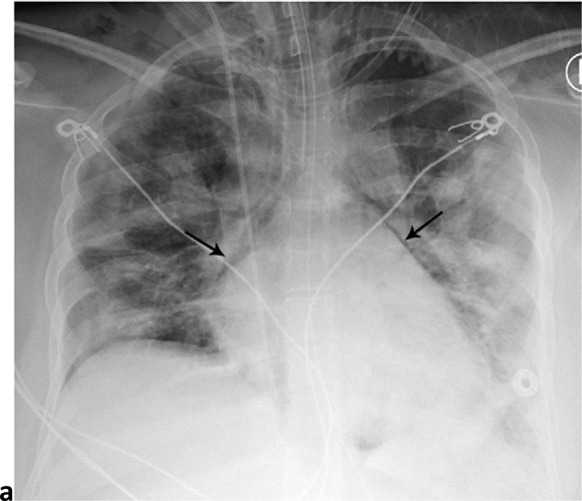 Pneumomediastinum and Bilateral Pneumothoraces, Separated by 7 days. 20-year-old woman intubated 5 days after admission. (a) Frontal chest radiograph depicts moderate pneumomediastinum (black arrows) and subcutaneous emphysema. (b) Frontal radiograph 3 days later demonstrates resolution of pneumomediastinum, and persistent mild subcutaneous emphysema. The superior and inferior extracorporeal membrane oxygenation catheters (arrowheads) were placed the preceding day. (c). Four days later, she developed large bilateral pneumothoraces (white arrows), and extensive subcutaneous emphysema.