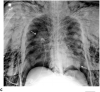 Pneumomediastinum and Bilateral Pneumothoraces, Separated by 7 days. 20-year-old woman intubated 5 days after admission. (a) Frontal chest radiograph depicts moderate pneumomediastinum (black arrows) and subcutaneous emphysema. (b) Frontal radiograph 3 days later demonstrates resolution of pneumomediastinum, and persistent mild subcutaneous emphysema. The superior and inferior extracorporeal membrane oxygenation catheters (arrowheads) were placed the preceding day. (c). Four days later, she developed large bilateral pneumothoraces (white arrows), and extensive subcutaneous emphysema.